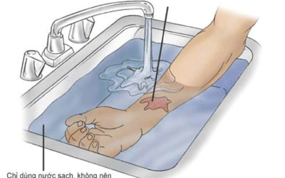 Cách làm giảm đau rát khi bị bỏng| Tổng hợp những cách chữa bỏng tại nhà