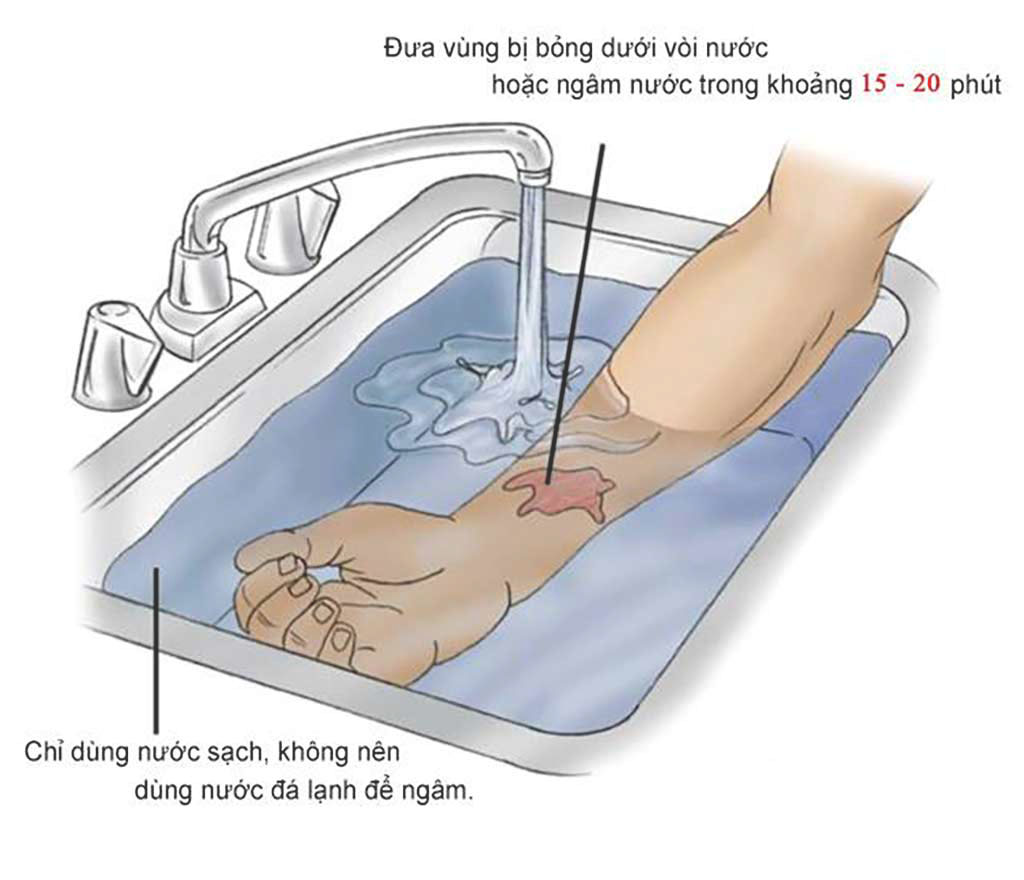Cách làm giảm đau rát khi bị bỏng| Tổng hợp những cách chữa bỏng tại nhà - ADC Foods